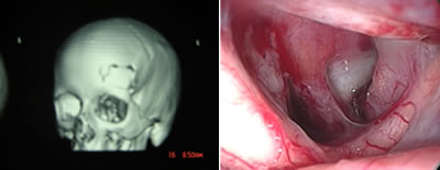 Craniotomia-minifrontal