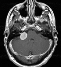 Neurinomas