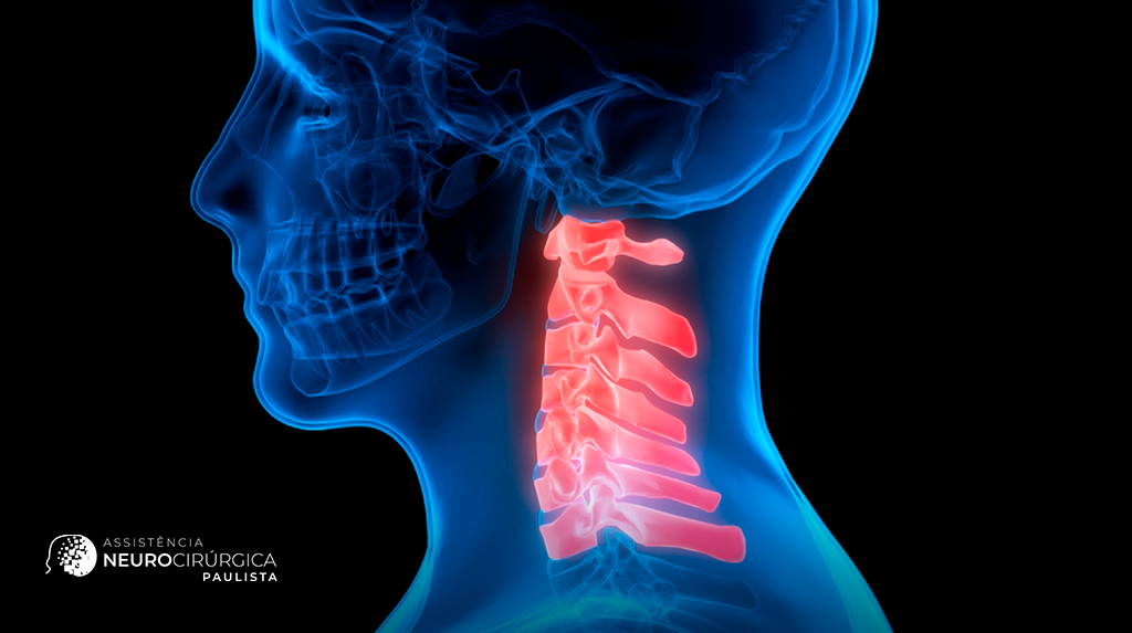 Sintomas de artrose cervical