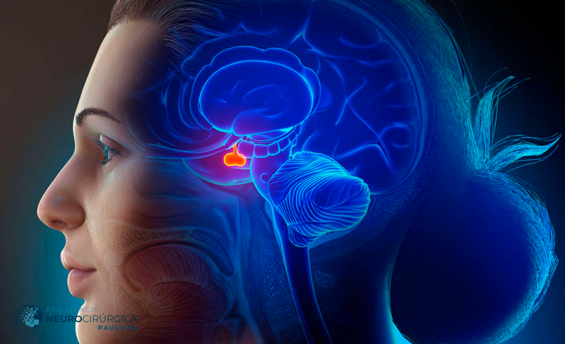 Abordagens cirúrgicas para tumores de hipófise: conheça as técnicas endoscópicas e microcirúrgicas