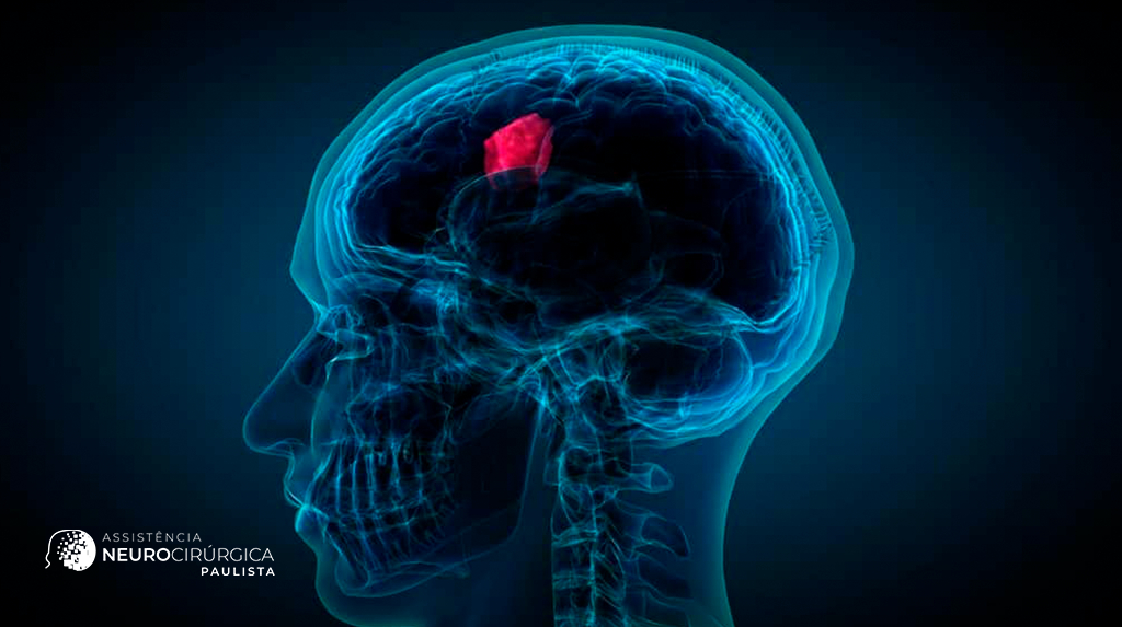 O que é meningioma e como pode ser tratado?