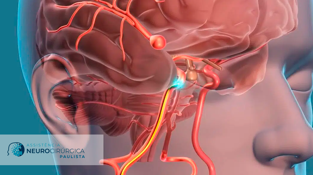 Tudo sobre o aneurisma cerebral