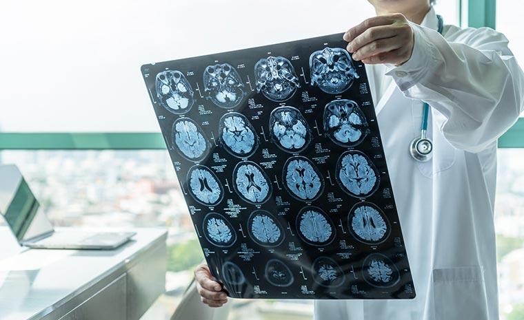 Neurinomas: Uma análise abrangente de diagnóstico e tratamento
