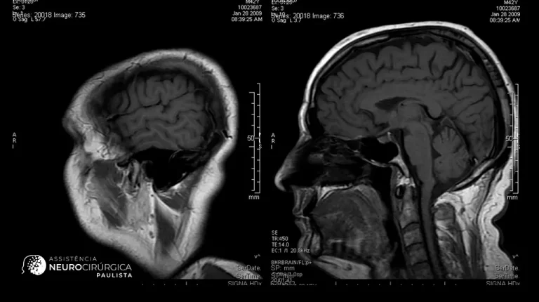 Como a ressonância magnética auxilia no diagnóstico do neurinoma do acústico?