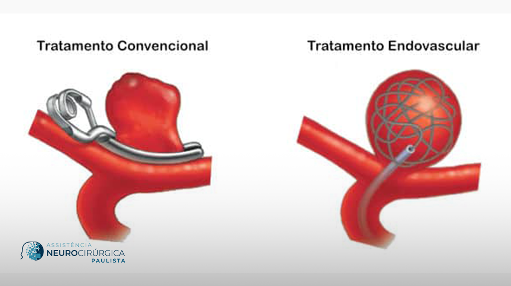 tratamento de aneurisma