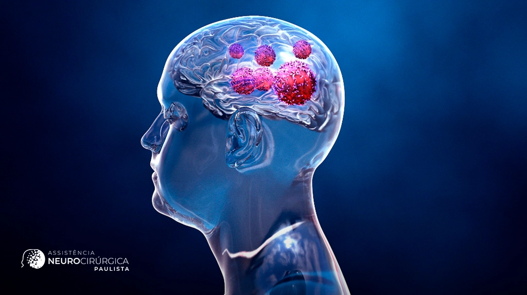 Diagnóstico Precoce de Tumores Cerebrais: A Importância da Neuroimagem