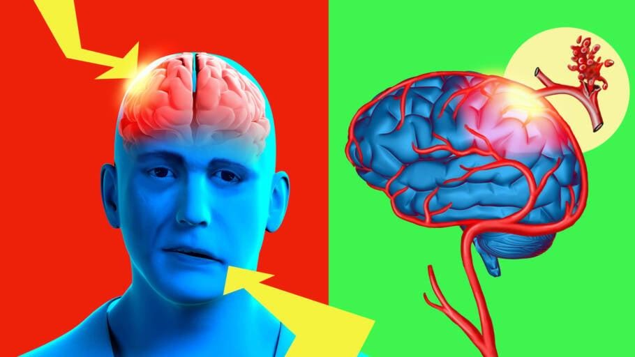 Enxaqueca com aura aumenta o risco de AVC? O que a ciência diz sobre essa relação