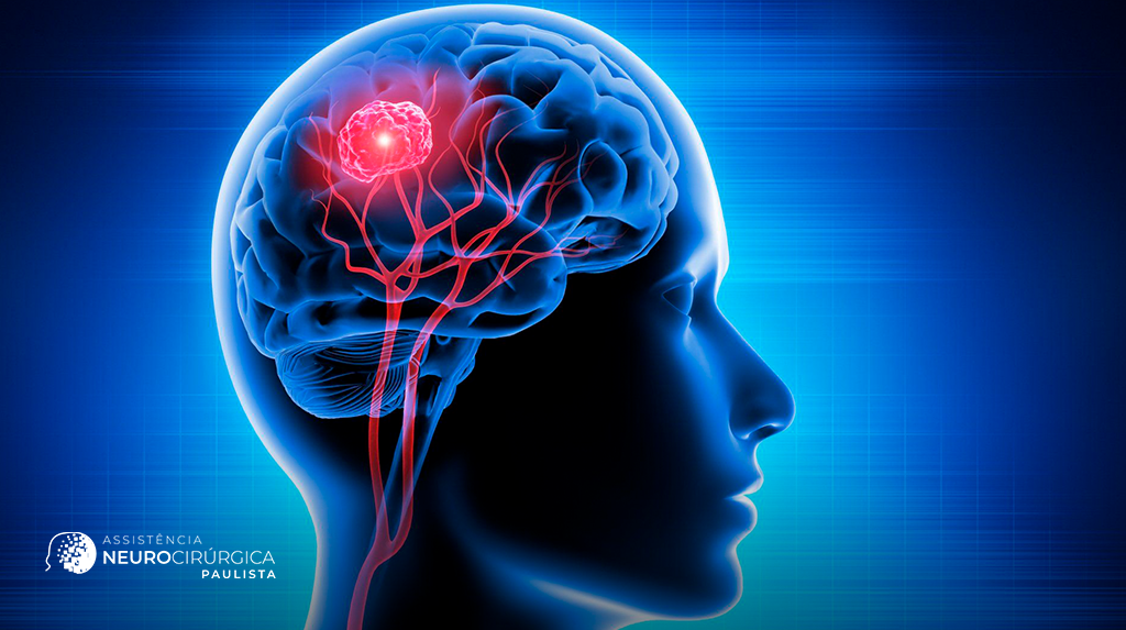 Mitos e verdade sobre a cirurgia de tumor cerebral