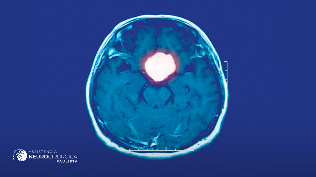 Mitos e verdades sobre o tumor de hipófise