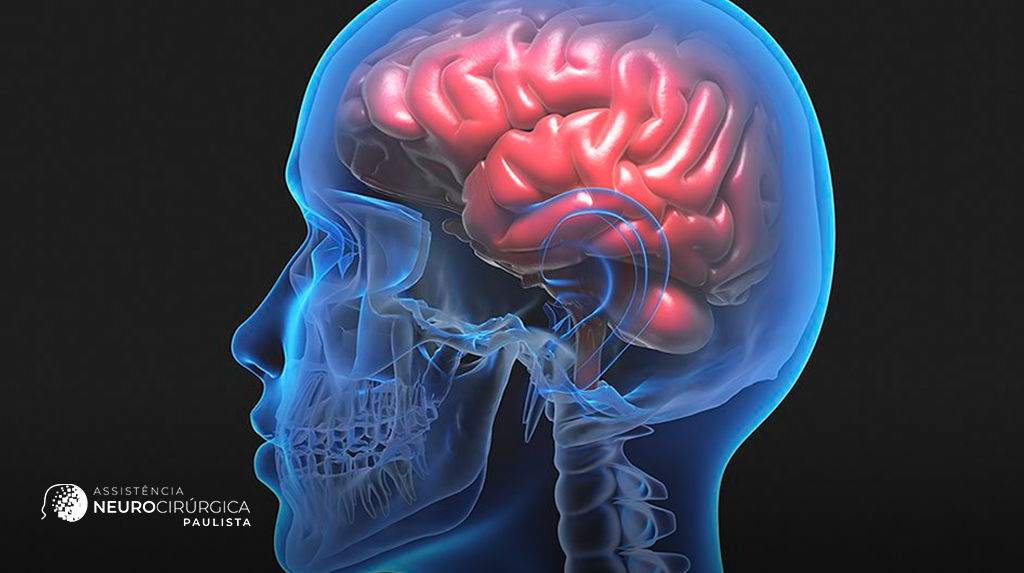 O que é um hematoma intracraniano e quais são os riscos?