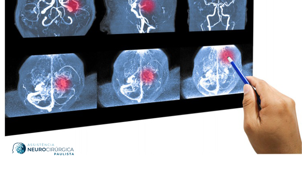 Aneurisma cerebral roto