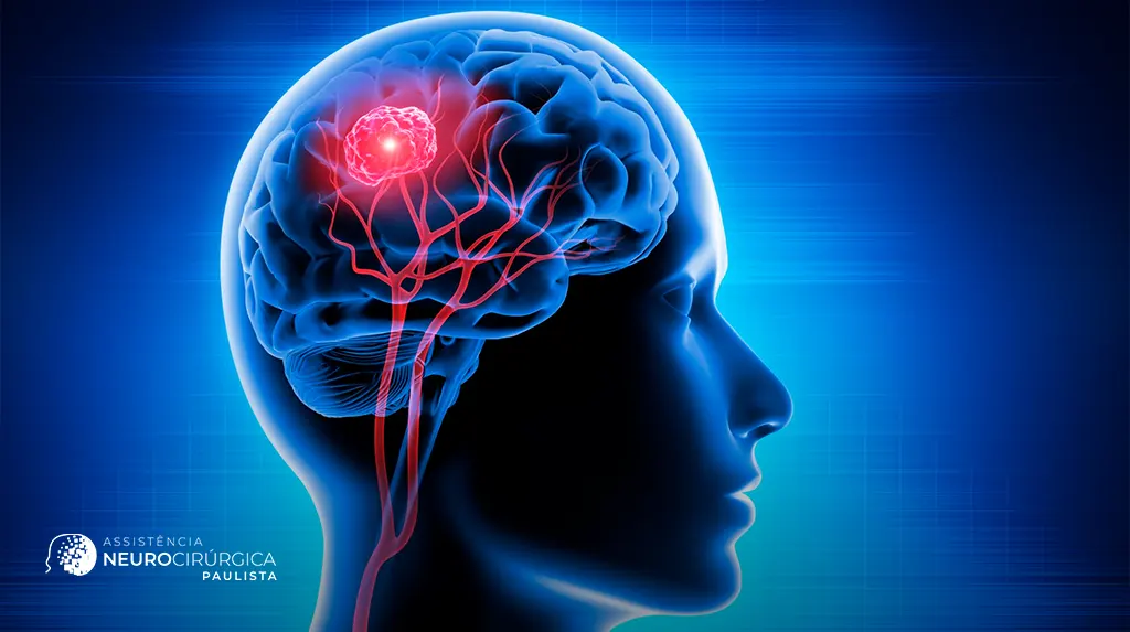 Recuperação após cirurgia de tumor cerebral: o que esperar nas primeiras semanas