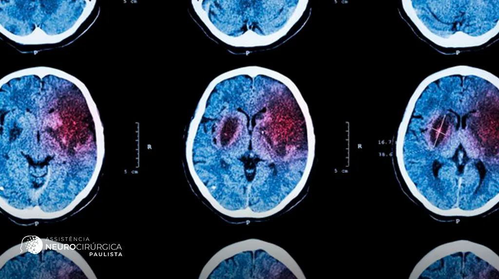Tipos de Lesão Cerebral e suas Causas