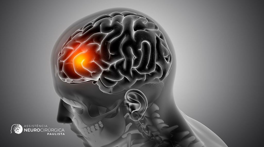 Tudo o que você precisa saber sobre tumores cerebrais: sintomas, diagnóstico e tratamento