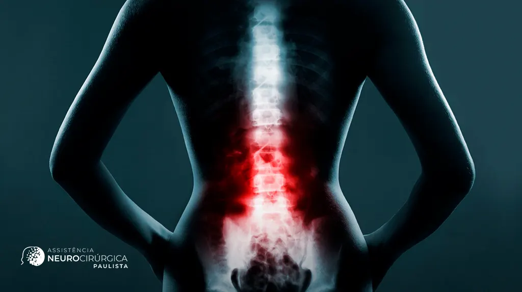 Tumores medulares: tipos, sintomas e diagnóstico